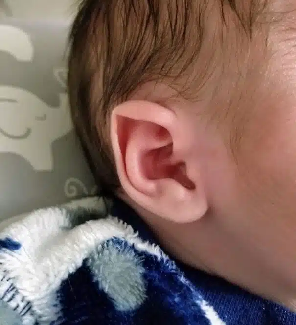 A Baby Born With Elf Ears
