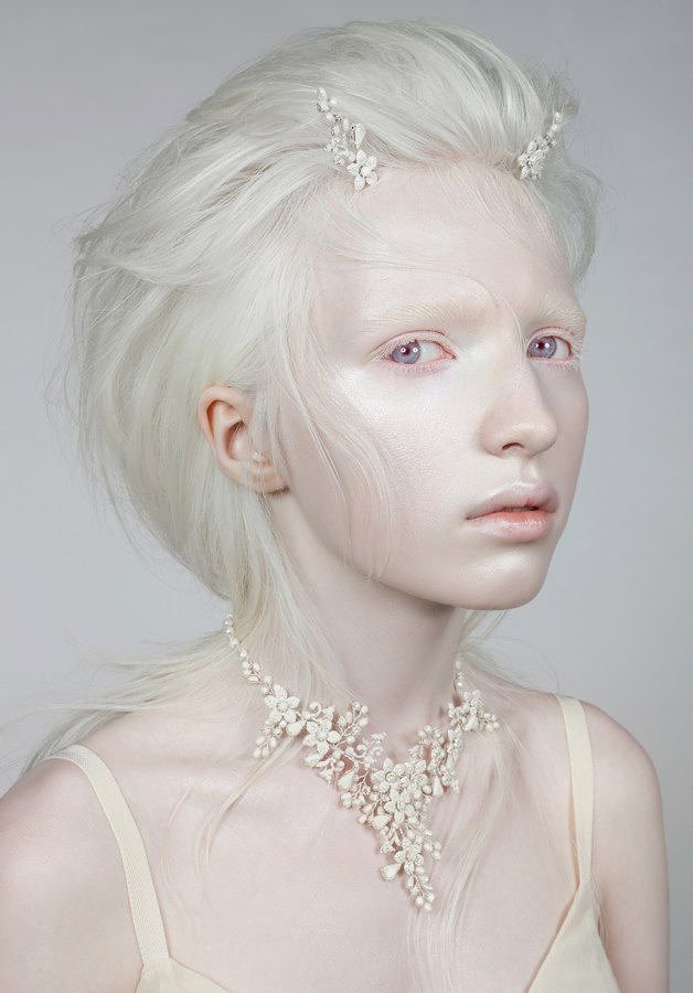 A Model With Albinism
