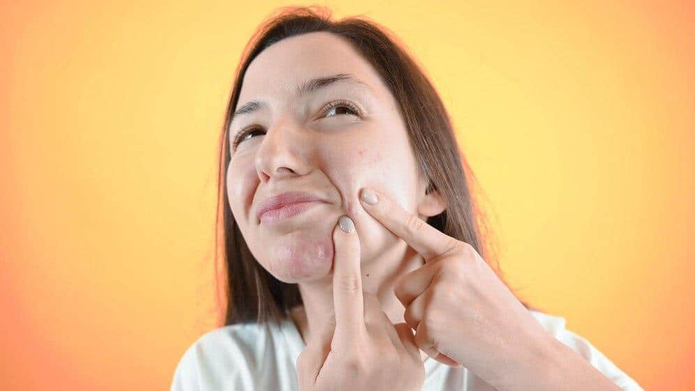 Natural Ways To Remove Pimples